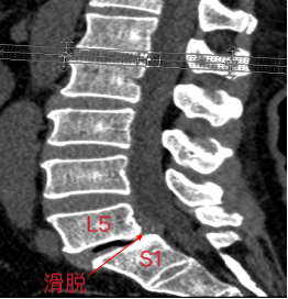 新突破！我院骨三科为患者背部“打孔”治滑脱